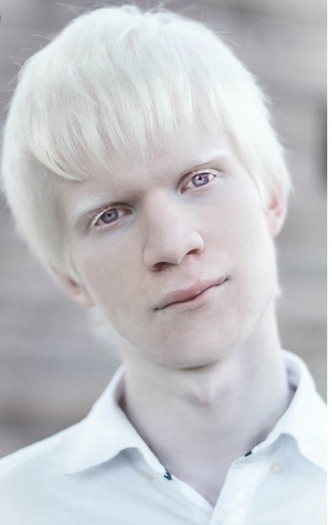 Что такое альбинос человек. Настя жидкова альбинос. Настя кумарова. Что такое альбинос человек. Окулокутанный альбинизм.