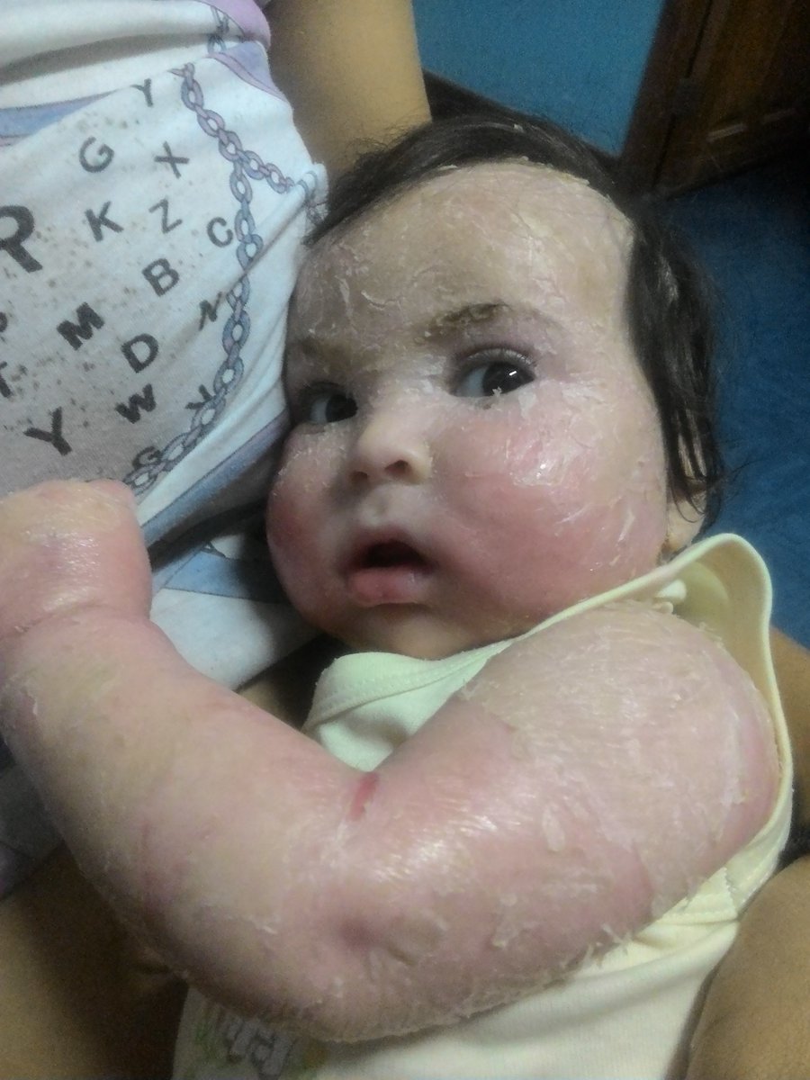 fundacionjesed's tweet image. Esta noche visitamos a Valeria González dx Eritrodermia su abuela nos llamo xq no tenía como comprar el antibiótico le llevamos para 2 días d tratamiento pañales un liolactil, recibe oxacilina cada 6 horas esta en el hospital d Cumana @AnonMundial @abreudaniela26 @alexagomez2000