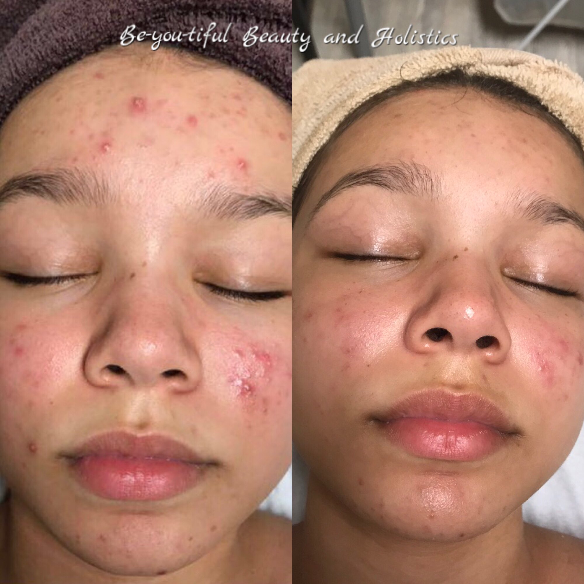 Youtube Deep Blackheads 87 - syowyus