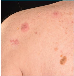 Are you a #nurse, #doctor, ward staff, #GP or allied health professional interested in knowing more about skin #cancer and its management? We’re holding a study day on Tuesday 26 June here at <a href="/qvh/">Queen Victoria Hospital NHS Foundation Trust</a> Cost is £50pp inc lunch. For more info or to book email qvh.skincancernurse@nhs.net