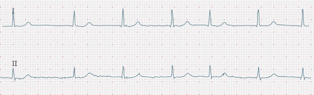 ecgbuddy's tweet photo. 77y/o female patient, long-standing arterial hypertension, diabetes mellitus, clinically stable without any symptoms.Takes an ACE inhibitor and metformin. No other medication.This is her ECG.Any suggestions on how to optimize her treatment?#ECG #ecgbuddy #studybuddy #doctorslife https://t.co/GfGUHiEmH6