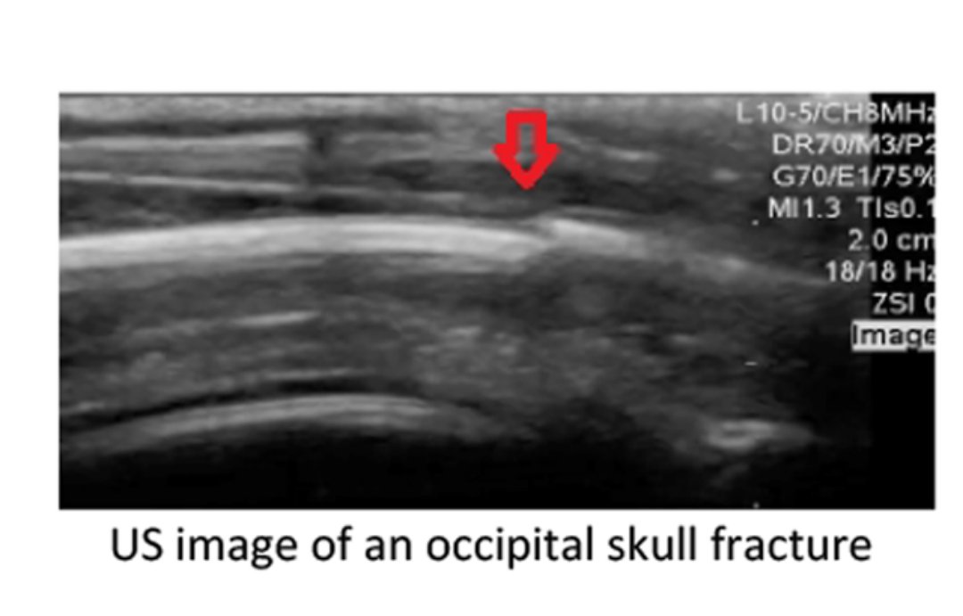 SabenaVaswani's tweet photo. Did you know that ultrasound can be a fantastic modality for assessing skull fracture and hematomas in the pediatric population? Dr. Alhamdani tells us about it! #ultrasound #usftw #SAEM18 @SAEMonline https://t.co/ECu9kefumF https://t.co/LjNhApvQTF
