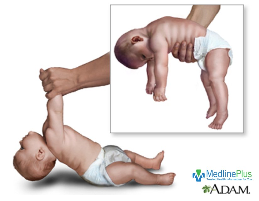 Spinal muscular atrophy