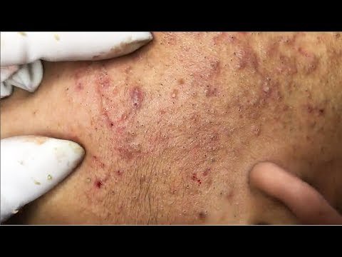 CrazyTech13's tweet photo. Removal Blackheads on The Face - How to Remove Acne Easy (Part 23)
https://t.co/DY9kDNM1ox https://t.co/PFHKLwMAMb