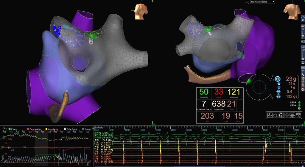 ep_nerd's tweet photo. Continuous pacing (10mA@2ms) during RF as surrogate of lesion durability. Loss of Capture corresponding to LSI of 4.5 to 5.5 and impedance drop of 10-15%. #AFib #HPSD_Abl @rogerwinklemd @PatrawalaRob @50wattdoc https://t.co/NgWfaUmCuw
