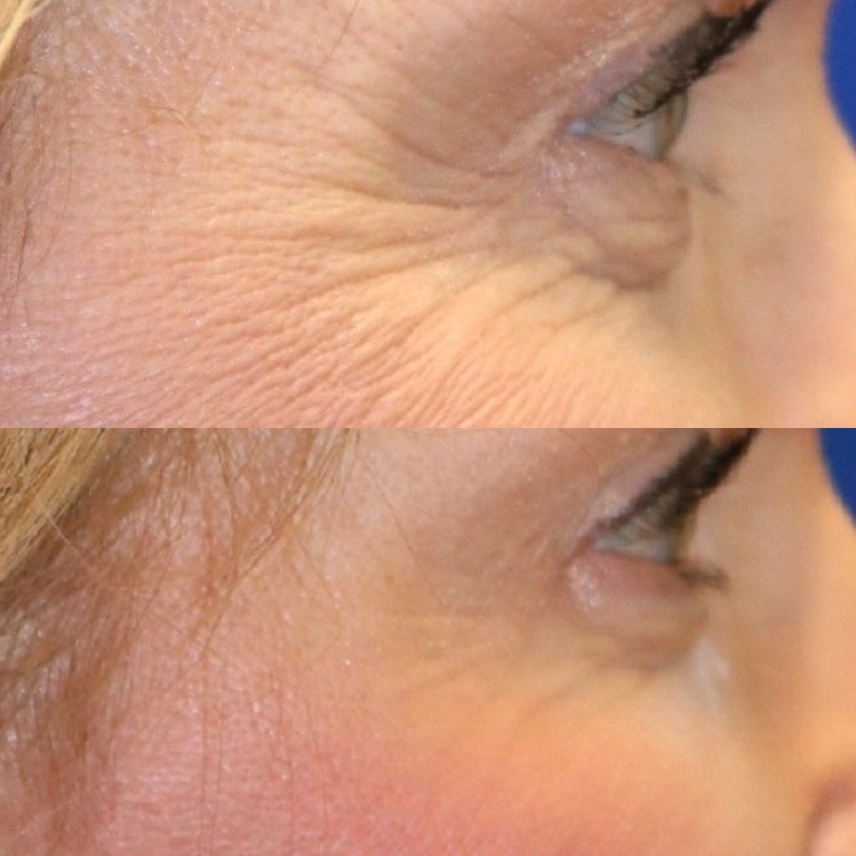 txfaces's tweet photo. #Botox was used here to soften those #crowsfeet around the eyes. A very natural and refreshed look was achieved!
#txfaces #beforeandafter #smooth #wrinklerelaxing #injectables #facialinjections #expertinjectors #friscotx #dallas #dfw #richardson #plano #McKinney #northdallas https://t.co/sBKy5QW9NB