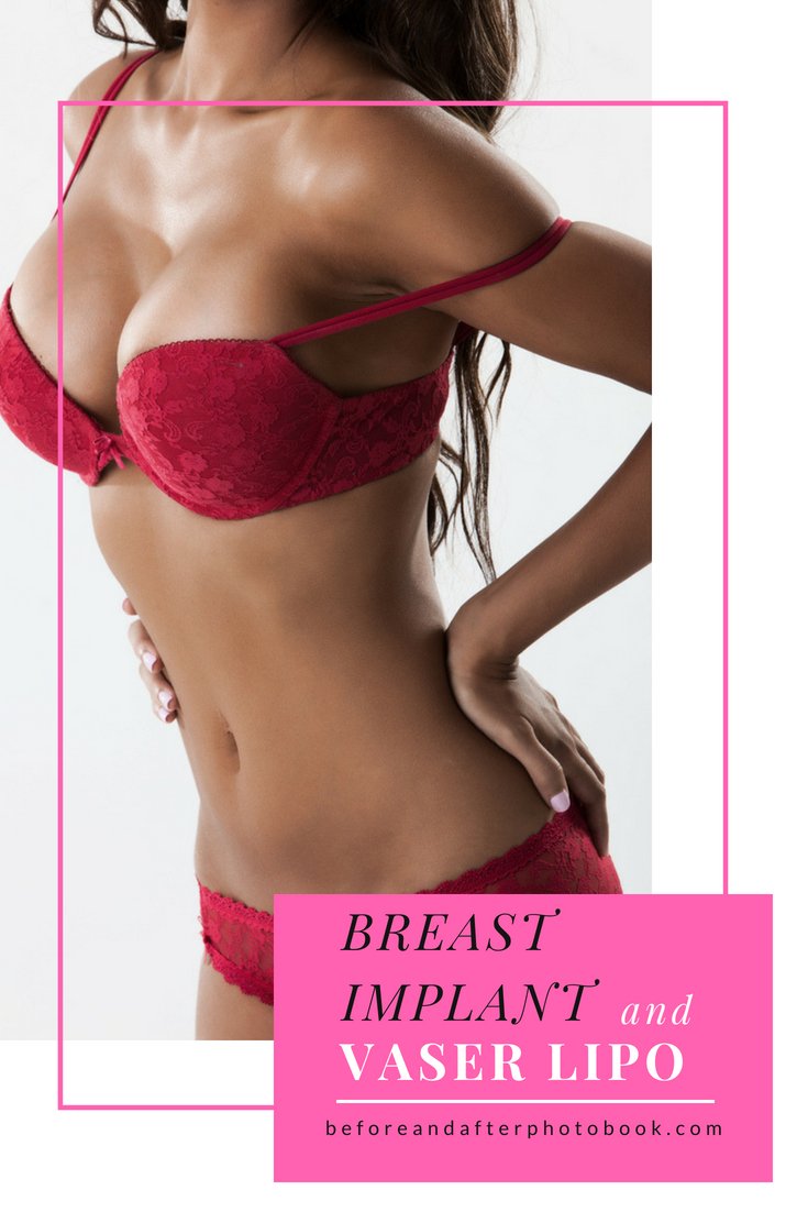 starwisetour's tweet photo. Want to be ready for the #summer
๐ฒ WhatsApp: +90 543 470 4709
#vaserliposuction #bbl #brazilianbuttlift #bblistanbul #brazilianbuttlifts #bbl #buttock #buttocksinjection #buttockaugmentation #buttocksaugmentation #buttimplant #fatinjection #buttlift #buttlifting #PlasticSurgery https://t.co/1u26on3V1z