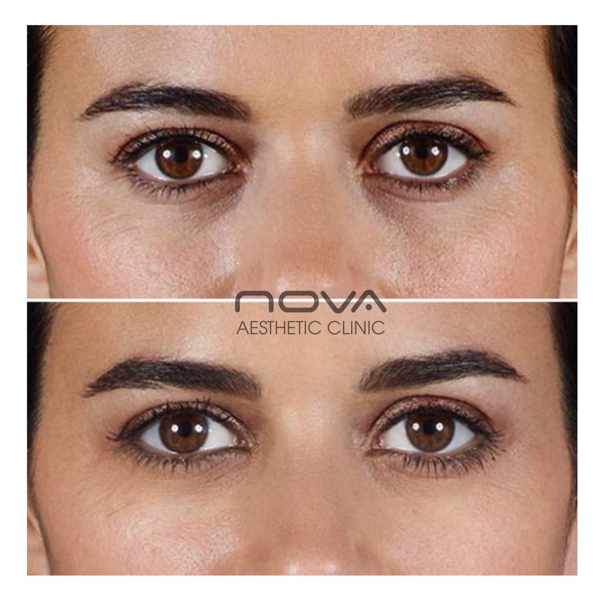 ✨DERMAL FILLERS at Nova ✨ Subtle enhancements can make such a huge difference - just look at the bags under her eyes! Dermal fillers are used to improve volume, soften and contour lines, folds, and wrinkles. #greenwich #beauty #dermalfiller #antiwrinkle