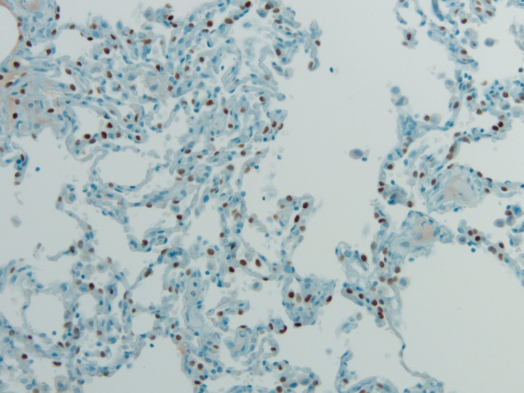 smlungpathguy's tweet photo. The numbers in the names of these nuclear immunostains add up to 114. What are they?
#pathology #pathmath #pulmpath #ihcpath @pembeoltulu @Missle @pbaleixo @histiocytosisX https://t.co/SjLDnlDCTa