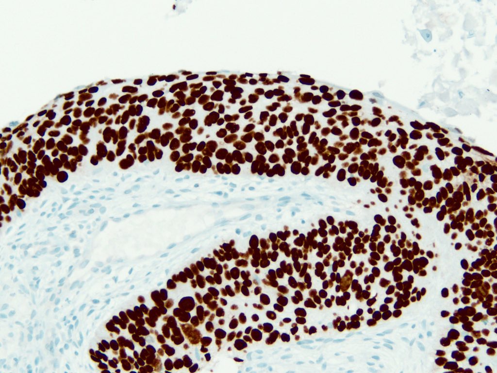 smlungpathguy's tweet photo. The numbers in the names of these nuclear immunostains add up to 114. What are they?
#pathology #pathmath #pulmpath #ihcpath @pembeoltulu @Missle @pbaleixo @histiocytosisX https://t.co/SjLDnlDCTa
