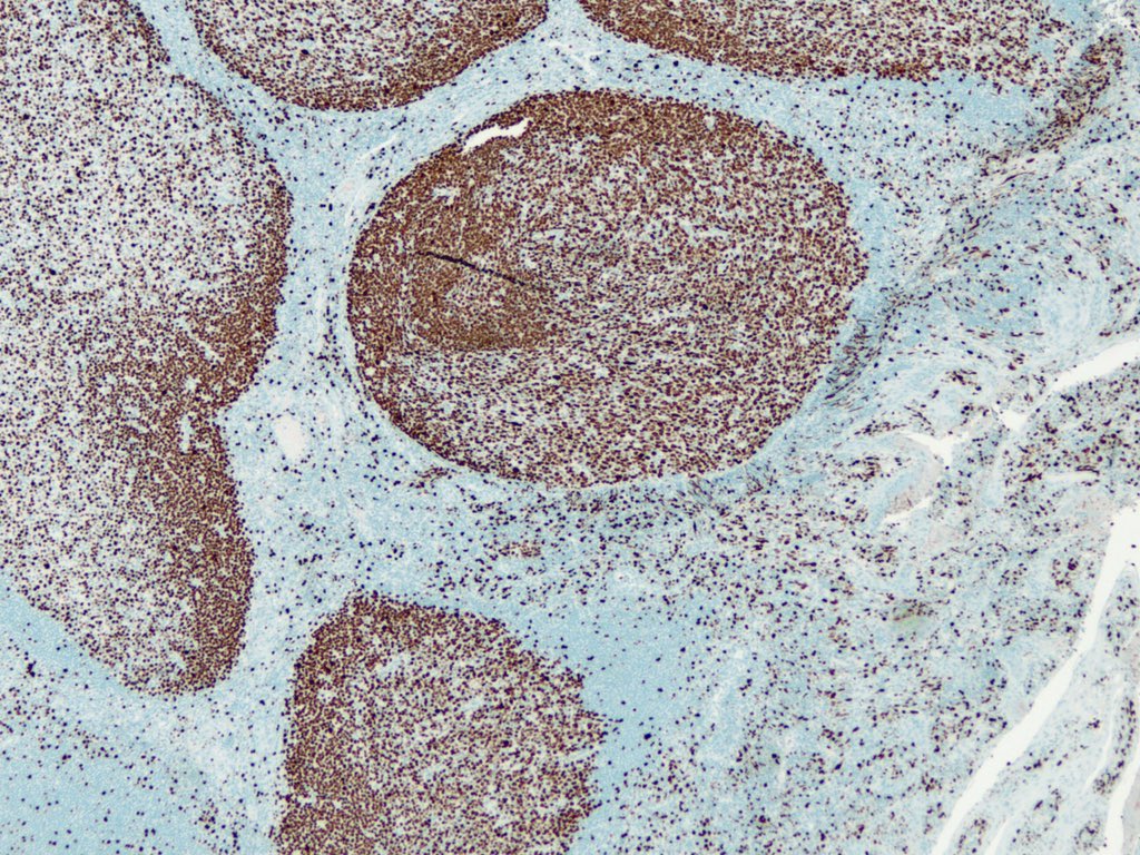 smlungpathguy's tweet photo. The numbers in the names of these nuclear immunostains add up to 114. What are they?
#pathology #pathmath #pulmpath #ihcpath @pembeoltulu @Missle @pbaleixo @histiocytosisX https://t.co/SjLDnlDCTa