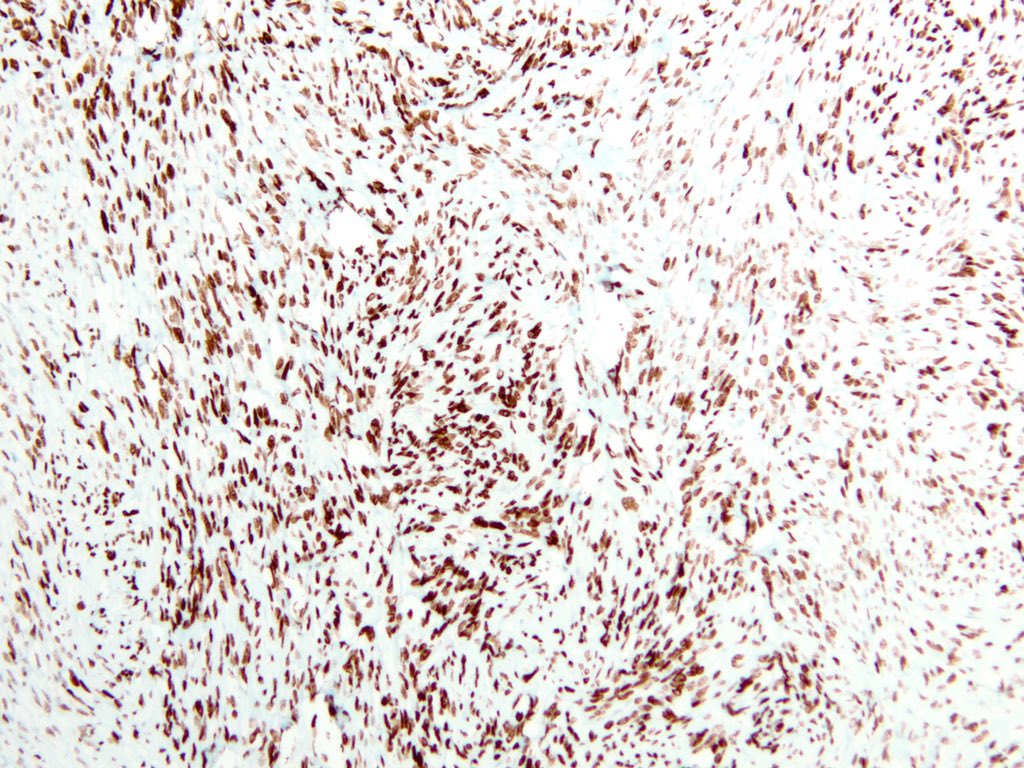 smlungpathguy's tweet photo. The numbers in the names of these nuclear immunostains add up to 114. What are they?
#pathology #pathmath #pulmpath #ihcpath @pembeoltulu @Missle @pbaleixo @histiocytosisX https://t.co/SjLDnlDCTa