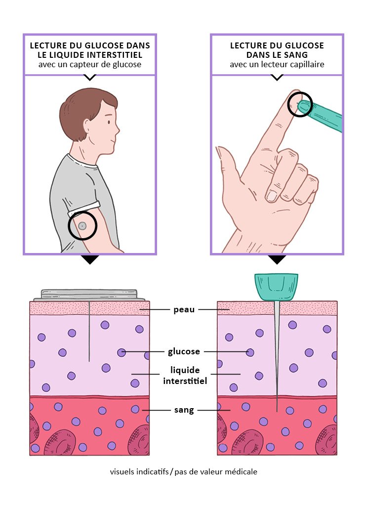 FedeDiabete's tweet photo. ▶ Glycémie et taux de glucose interstitiel : quelle différence ?
Une illustration pour comprendre l'essentiel des 2 principes de mesure du glucose en toute simplicité ! #glycémie #capteur #interstitiel #sang
👉 https://t.co/zb47Q6A0TV https://t.co/OyIaIy2Ajg
