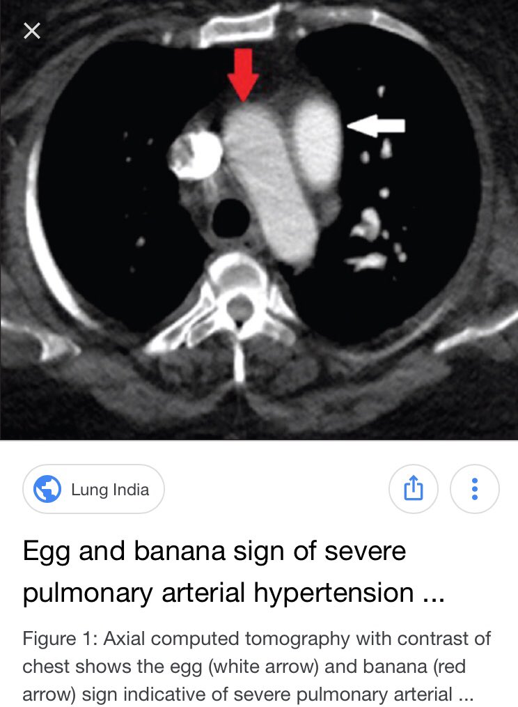 Egg and banana sign (pulmonary hypertension), Radiology Reference Article