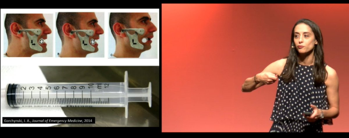 EssentialsofEM's tweet image. Fast track pearls by Tarlan Hedayati for jaw dislocation: place a 5 or 10cc syringe on a patient's posterior molars and roll it back and forth (anteriorly and posteriorly)! #EEM2018 #jawdislocation #tricksofthetrade @chitwngurl