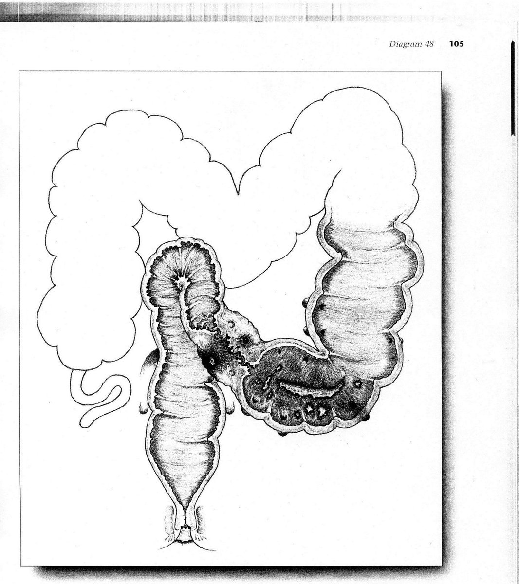 Myth #5: Diverticulitis gets worse over time. Not true! The first attack is typically the worst attack, and the risk of progression from uncomplicated disease to a surgical emergency is less than 5%. Read our practice parameters here: ncbi.nlm.nih.gov/pubmed/24509449
