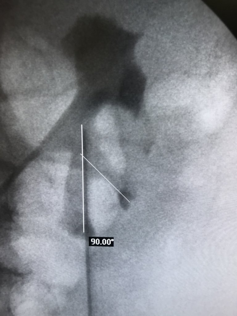 UrologoEdgar's tweet photo. 😞I’m not in #aua18 so

Limiting kidney with 30 ml/min with 2 unsuccessful RIRS (not in my center) 
We made #SMP of 22 min with pneumatic lithotripsy  because we are poor and we left a residual in lower calyx that was an anterior  calyx
☝🏼🤓
#SMP #StillnotPerfect #MexICan https://t.co/k9aqEcEf1p