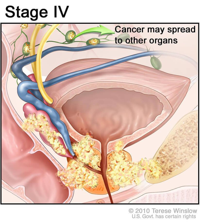 Researchers have identified a form of metastatic #prostatecancer that doesn't rely on hormones to fuel its growth: cancer.gov/news-events/ca…