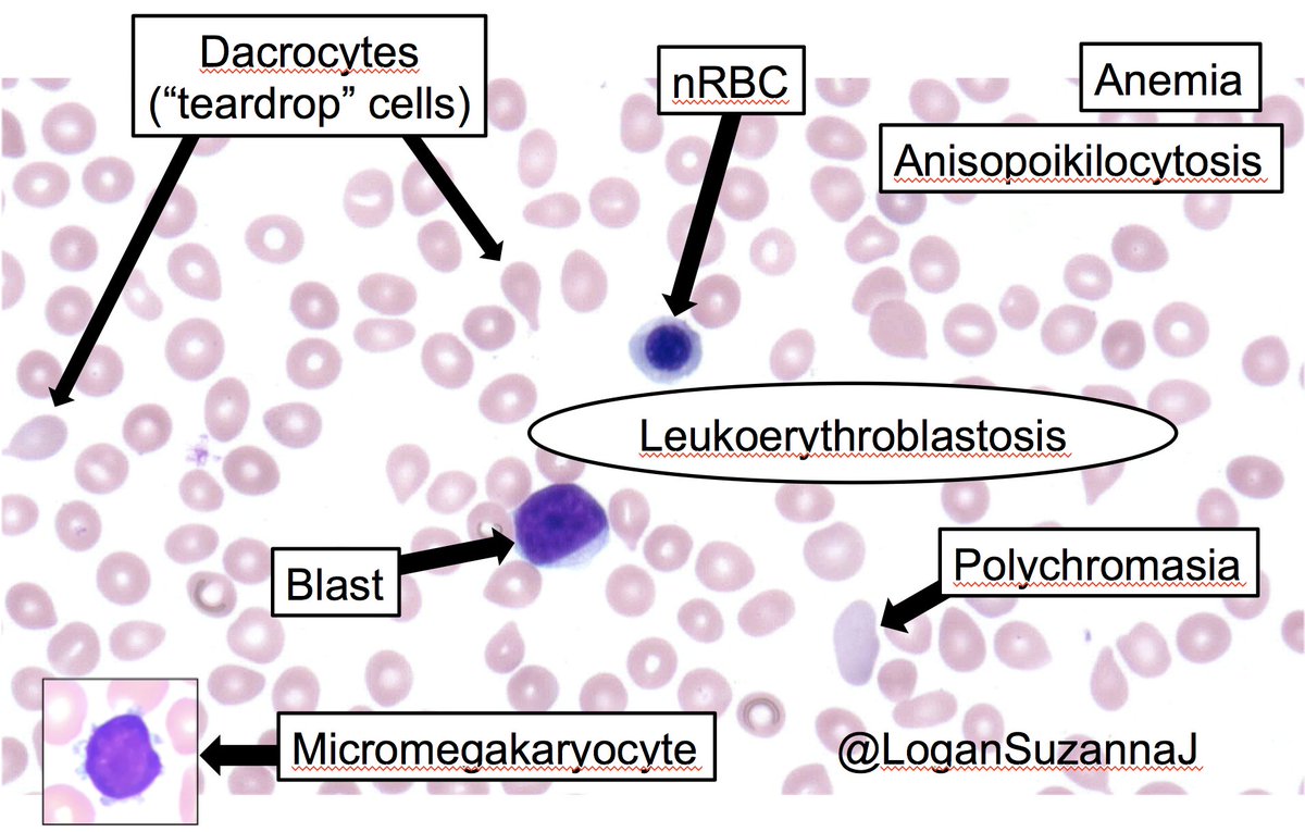 Leukoerythroblastosis and myelophthisic anemia can be associated with any marrow-replacing process. In this case, the likely etiology was post-essential thrombocythemia myelofibrosis.