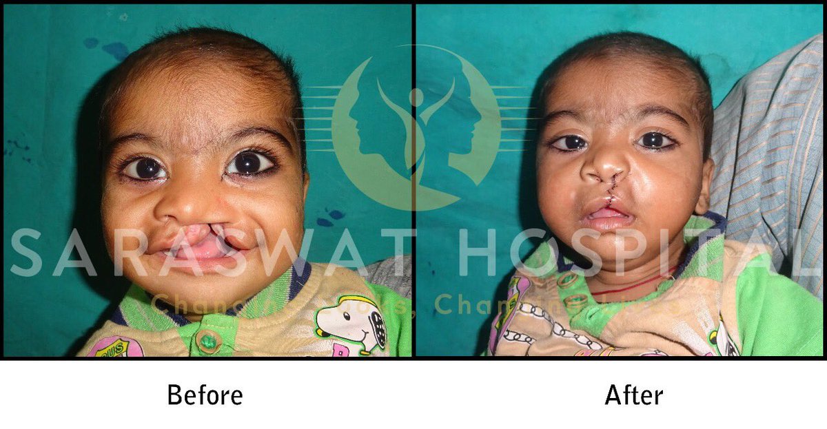 Same Baby (Ganesh) after 1 day of his Surgery. There is some swelling, which will subside in a week or so.