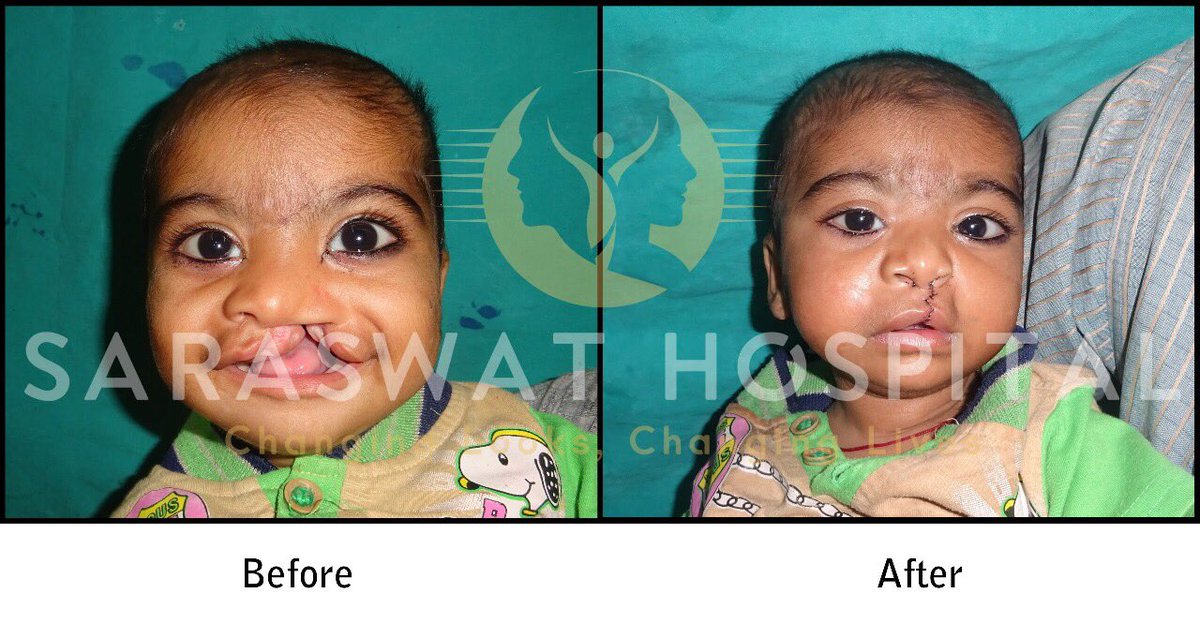 Same Baby (Ganesh) after 1 day of his Surgery. There is some swelling, which will subside in a week or so.