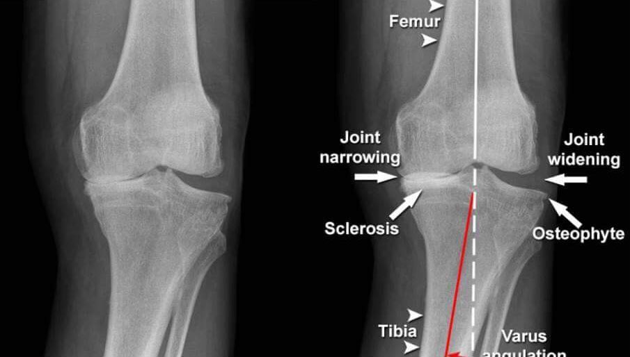 Subchondral Sclerosis