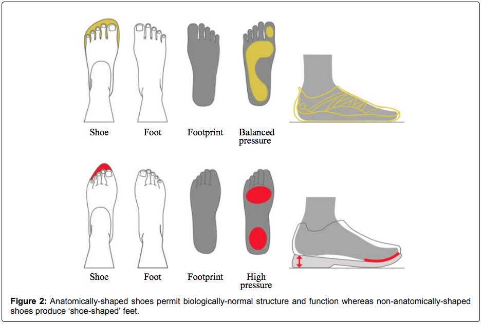 Opinions are like arseholes; everyone has one and most of them stink but not this one! Scientific opinion piece. Anatomically-shaped shoes permit biologically-normal structure and function. International Journal of Sports and Exercise Medicine clinmedjournals.org/articles/ijsem…
