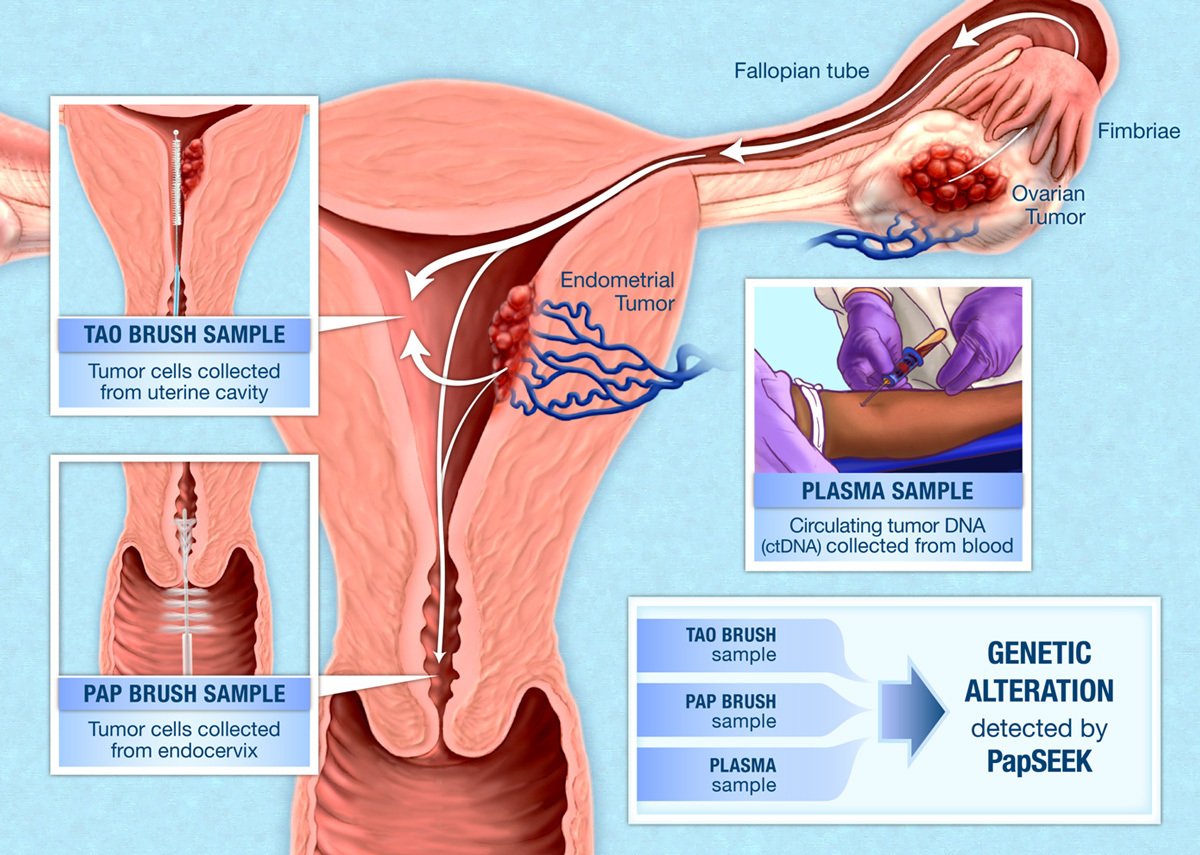 An experimental screening test can detect some endometrial and ovarian cancers at their early, more treatable stages: cancer.gov/news-events/ca… #CancerCurrents