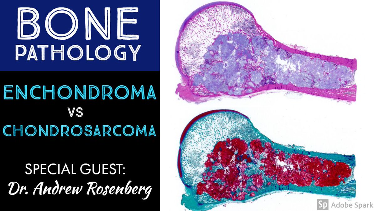 Do you struggle with distinguishing enchondroma vs low grade chondrosarcoma? Me too! In this video, bone pathologist Dr. Andrew Rosenberg shares his views &amp; tips for sorting out this challenging differential. buff.ly/2rK8fE8 #pathology #bstpath