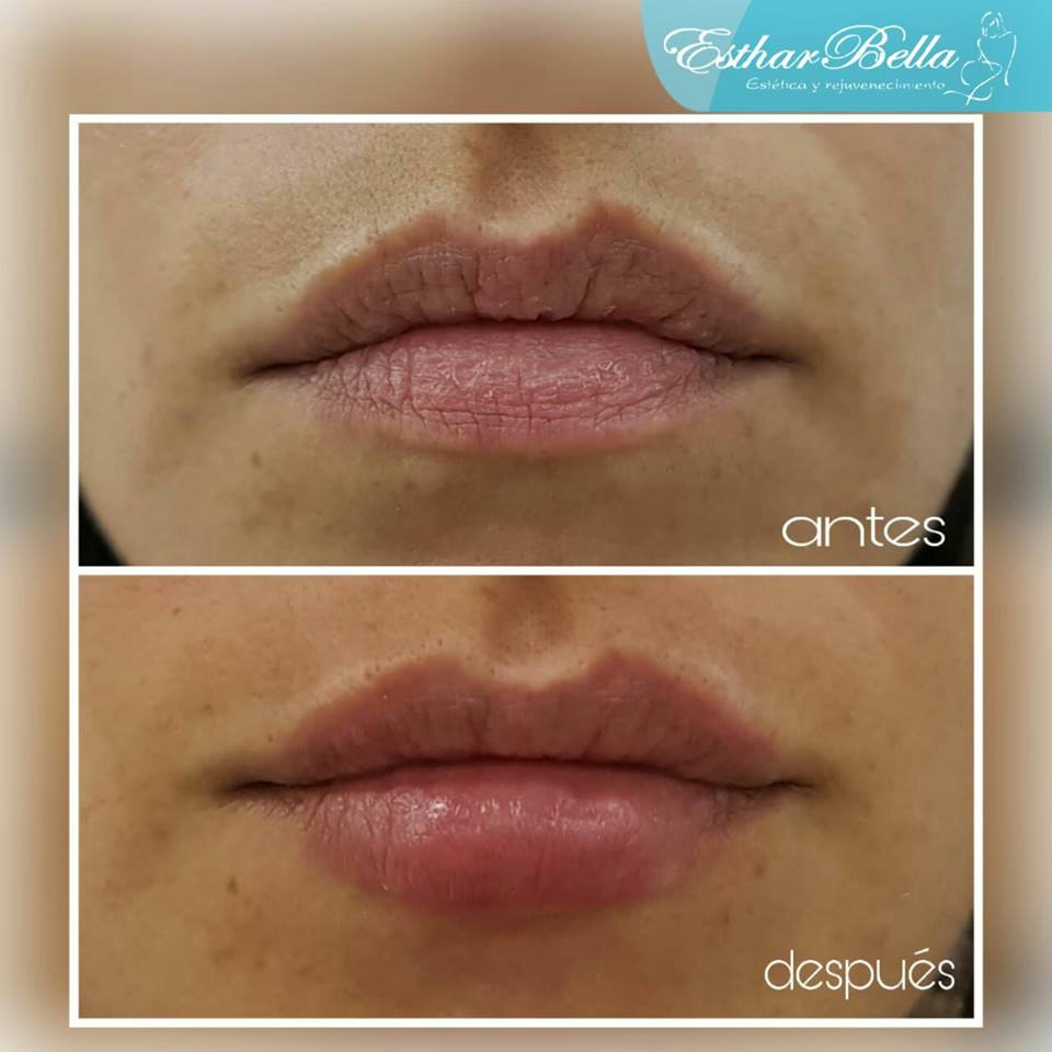 estharbella's tweet photo. Promocion  ❤❤
Princess® Ácido Hialurónico Austria 20%Dscto. ⚘⚘⚘⚘
¡Conserve su belleza!🌷Atenuar lineas de expresión finas?
Dar volumen a sus labios?
Princess un producto universal adecuado para  tratamientos estéticos
Esthar Bella
Av. Larco 345 Of. 119 - 120 Miraflores https://t.co/iBHwR0X8qQ