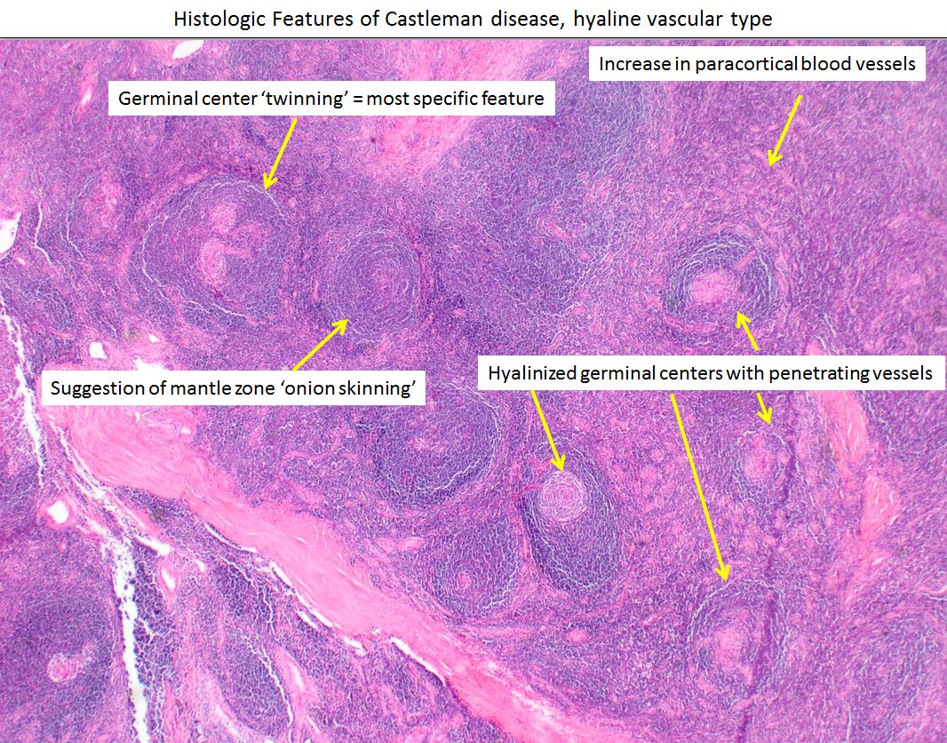 Spot on observations everyone.  This was  a very classic example of HV Castleman disease.  A lot of #hemepath fixates on cytologic features of cells, but the #lppath appearance gives away the diagnosis and/or a narrow DDx in virtually every case.