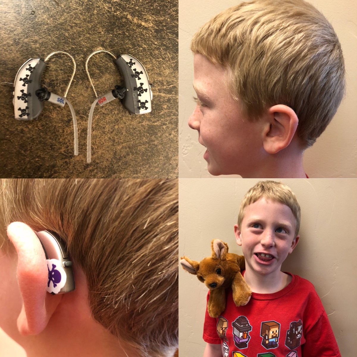 This kind boy was fit with a <a href="/widex/">WIDEX</a> CROS set up today to manage his single-sided deafness. We love his sticker choice for his new #hearingaids ☠️ 

#pediatricaudiology #hearingloss #noholdingback #deafness #drjeepspeeps
