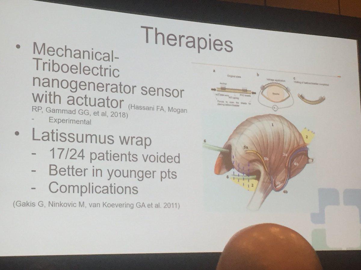 YSL_MD's tweet photo. #AUATakeaway - @doc_h_wood: #underactivebladder is a “mixed bag” diagnosis - narrow down what you are treating to facilitate discussion of treatment options. Also, remember that UAB is a key area of @NIDDKgov available funding. Ripe area for new research ideas!! #SUFU18 #AUA18 https://t.co/uvUhKXeaJ9