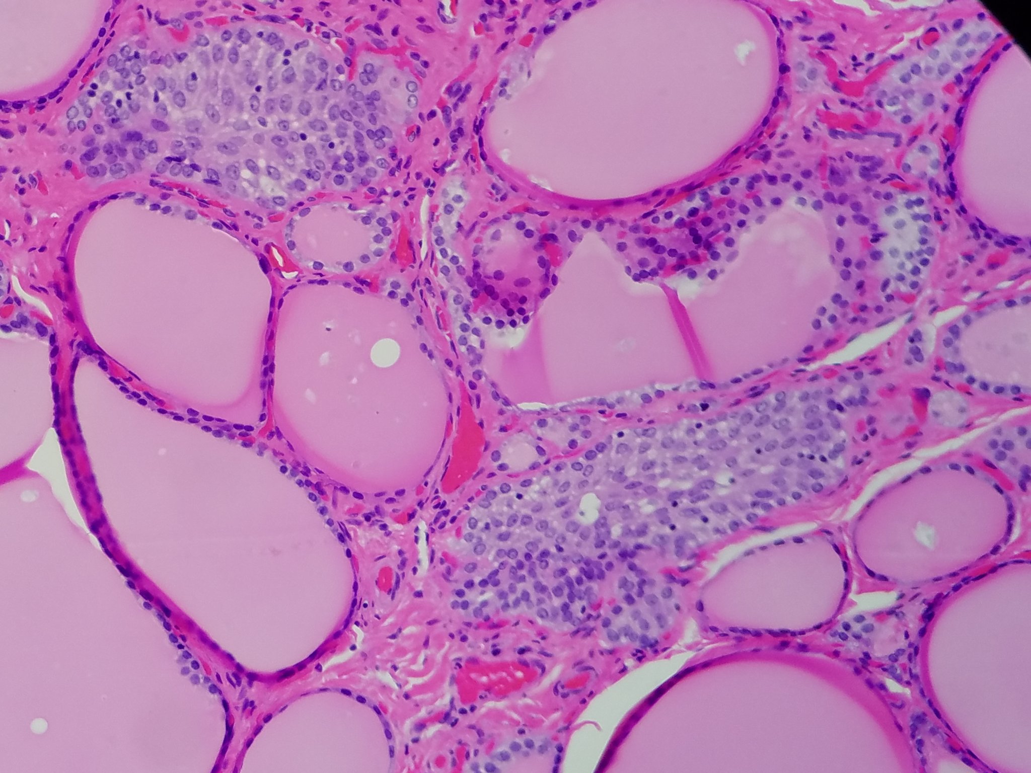 Multinodular Goiter Histology