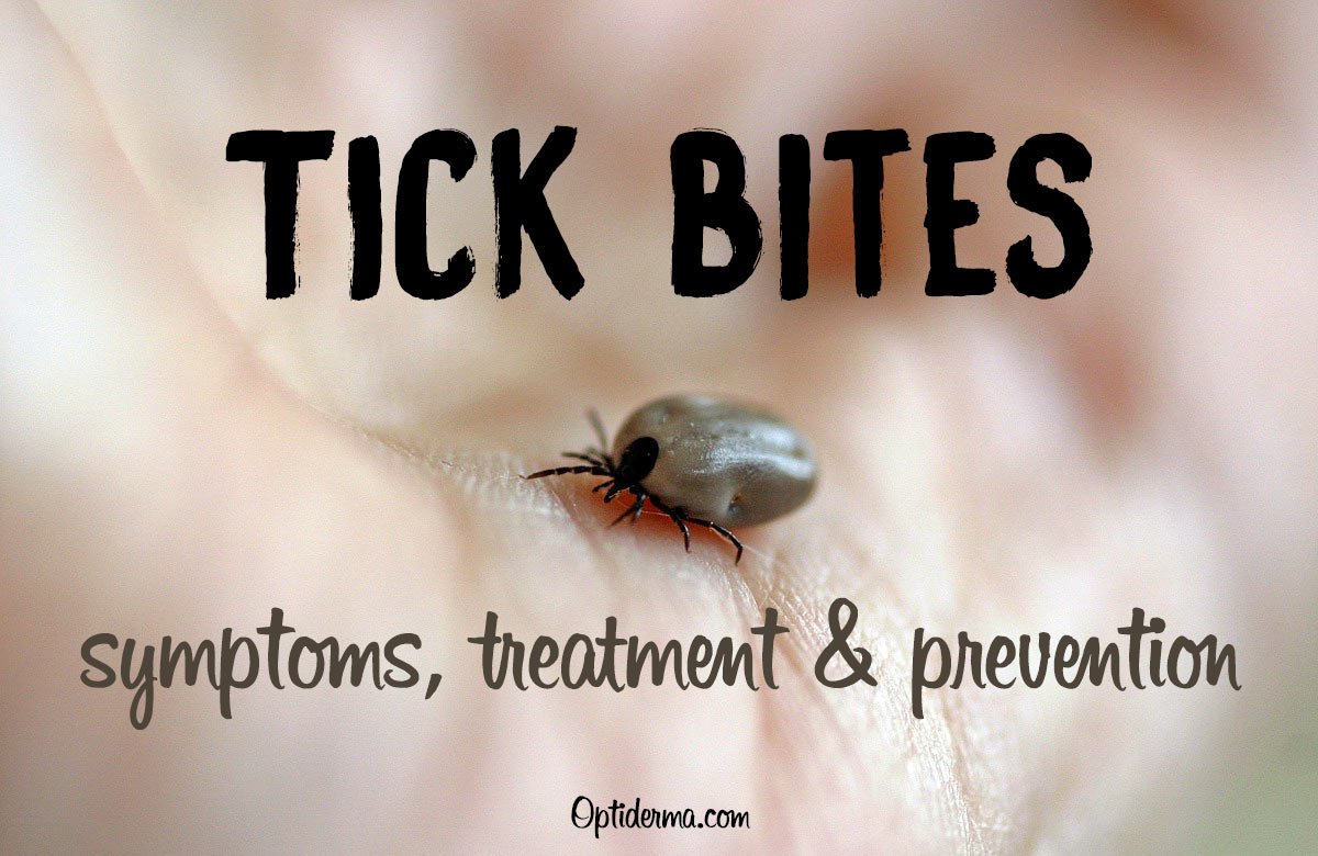 optiderma's tweet image. Been bitten by a tick? Check this out sumo.ly/Uiy4 via @optiderma