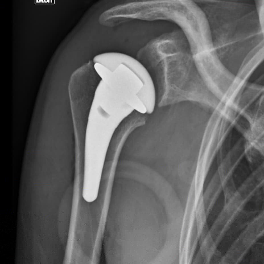 The new shoulder. Have to be off drums for awhile for healing, but hoping and praying for a good recovery and eventually relief. Thank you!
#drums #drummer #shouldersurgery #shoulderreplacement
