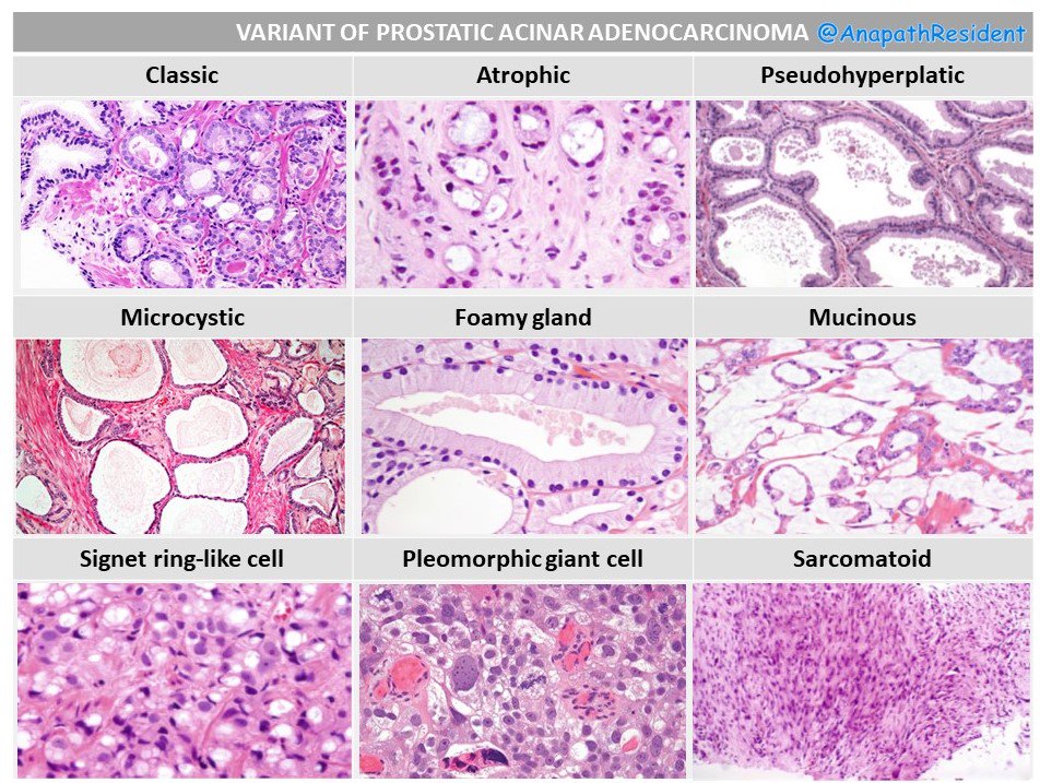 acinaris adenocarcinoma A prosztatitis okai korai életkorban