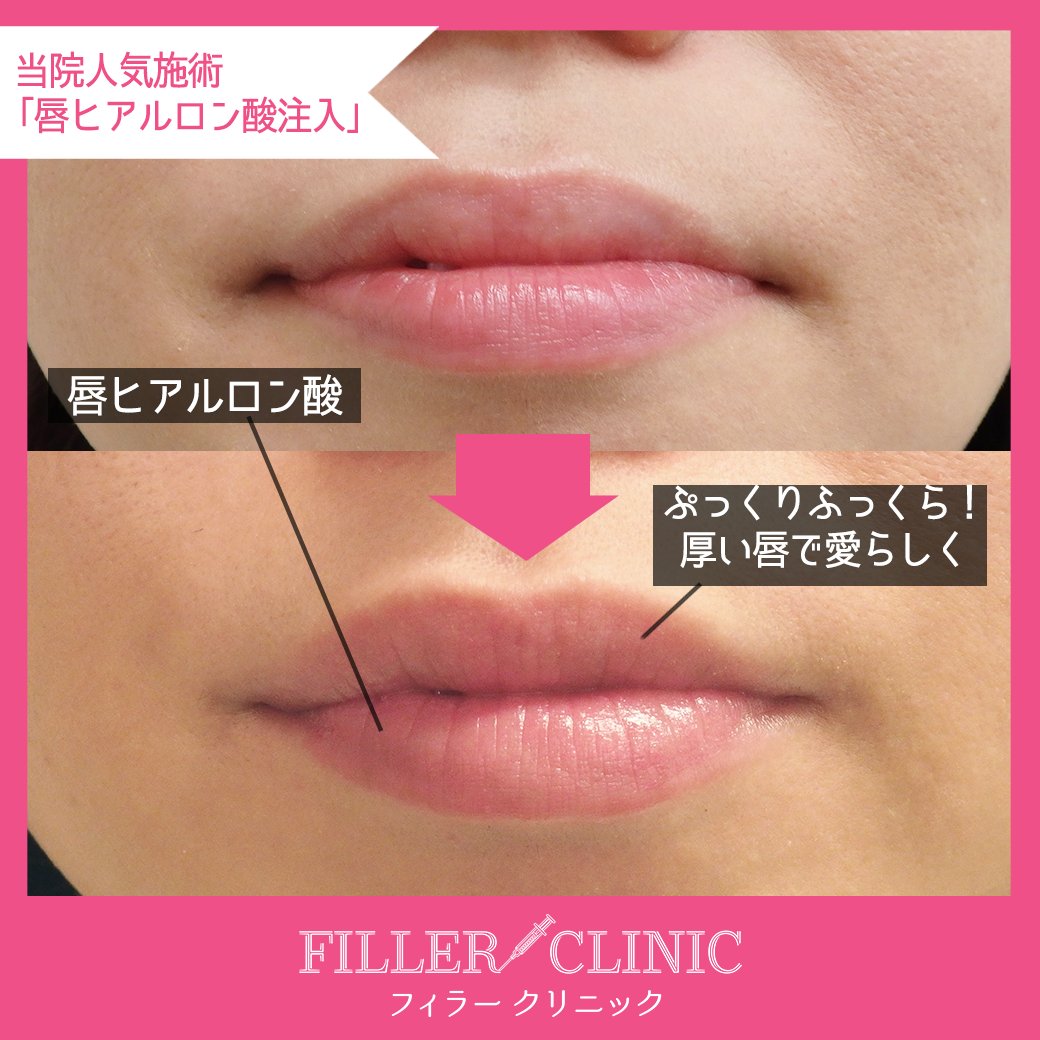 フィラークリニック 公式 施術時間はたったの数分 ぷっくり潤った愛らしい唇が実現します お得な長持ちヒアルロン酸 唇におすすめ 何ccでも 0 1cc 3 0円です 詳しくはこちら T Co Luty1fw7zr T Co Lo86lemsjk