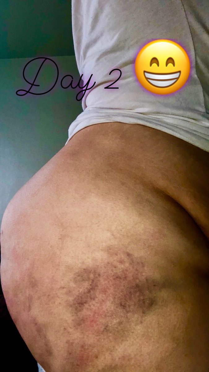 confidentBeauty's tweet photo. Weekend to remember
#May2018 #playdatefun #happysub #bdsm #thisisreallife #kink #showyourmarksoffwithpride https://t.co/SyTWY5Cu6j