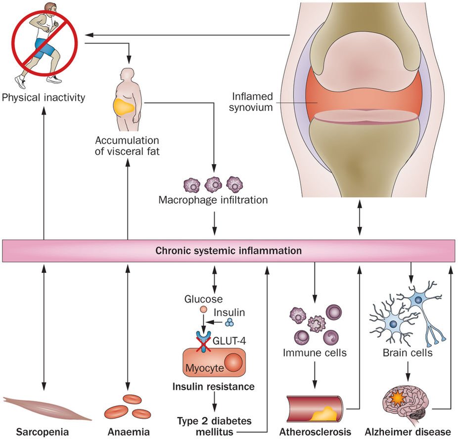 #Exercise as an anti-inflammatory therapy for rheumatic diseases—myokine regulation
#exercise #inflammation #therapy #rheumaticdisease
@GGPA17 @PhysioSA @apaphysio @thecsp