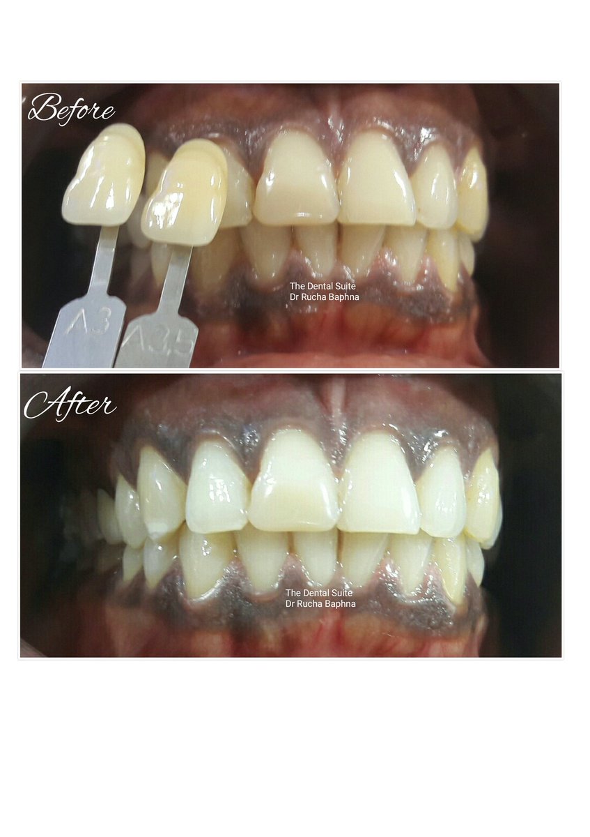 rucha_baphna's tweet photo. Yes magic happens!! 
Its called Teeth Whitening 

To know more call 022 26231393 / 9619066672
Or log on to https://t.co/9xjmiwkp6S
#TheDentalSuite #Dentist #DentistMumbai https://t.co/n0obgHe66m