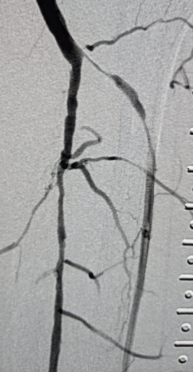 SOBE_Vascular's tweet photo. 71 yo M  RC4 #CLI, 5th #MicroMedical stent implant using #SOBEballoonprotection technique for AT ostium, #stopthechop #CLIFighters 

@EVToday @JVIRmedia @NCVHonline @CathLabDigest @VascularSVS @DrBobBeasley @TimYatesMD @BOlivieriMD @Mustapja @FadiSaab17 @bsc_pi @DrBTKatzen https://t.co/NezmaNFvHD