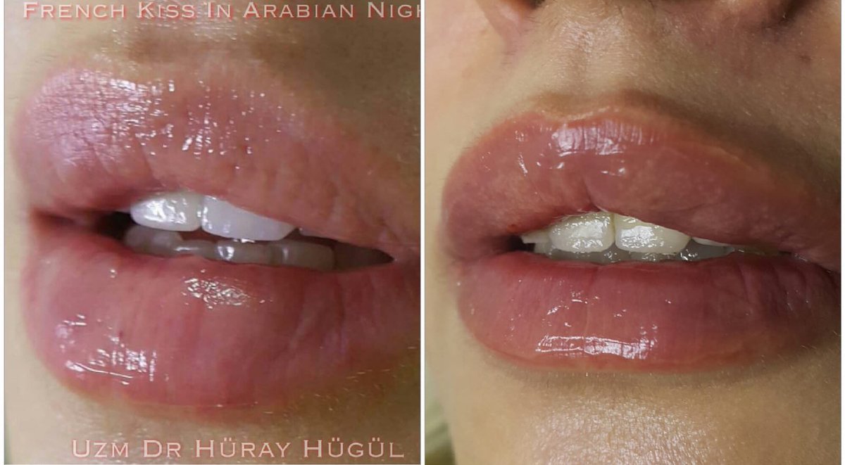 FRENCH KISS DUDAK DOLGUSU 05454047222 ve 02423240003 Lara Vatan Bilgisayar Yanı UZM DR HÜRAY HÜGÜL