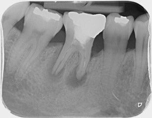 rootcanaluk's tweet photo. #therootcanalclinic #endodonticretreatment #MTA #savingteeth #endodontics. Pre / immediate post op and
looking good and ongoing healing at 1 year postoperative in a LR6 which had #russianredcement. https://t.co/xOtqNLKjwa