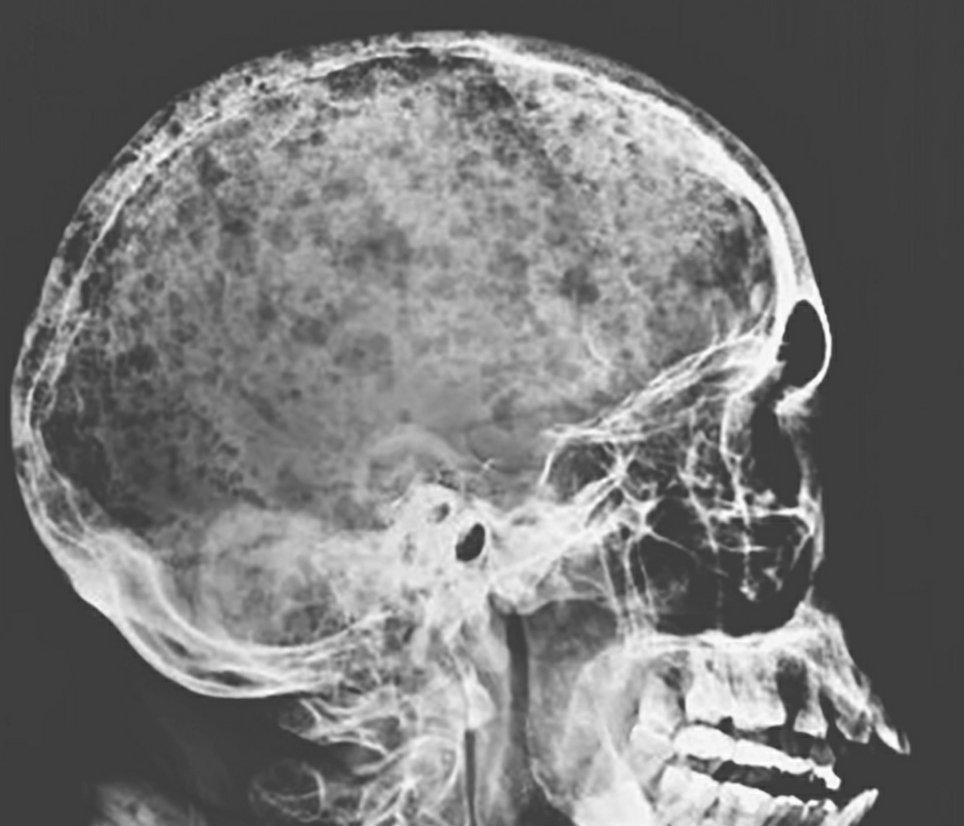 Alberto on Twitter: "La imagen clínica del @NEJM: un cráneo en "sal y