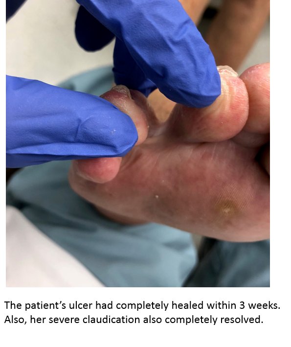 Sabeen Dhand (@sdhandmd) on Twitter photo #IO meets #PAD | #iRad can treat cancer & vascular disease
Pt w liver cancer, treated with #embolization 3 years ago. On clinic follow ups, patient complained of progressive claudication and recently developed ulcer at 3rd-4th toes.
No problem!
@rkryu <a href="/kmadass/">Kumar Madassery</a> <a href="/AlexCVIR/">Alexandria CVIR</a> #IO meets #PAD | #iRad can treat cancer & vascular disease
Pt w liver cancer, treated with #embolization 3 years ago. On clinic follow ups, patient complained of progressive claudication and recently developed ulcer at 3rd-4th toes.
No problem!
@rkryu <a href="/kmadass/">Kumar Madassery</a> <a href="/AlexCVIR/">Alexandria CVIR</a>