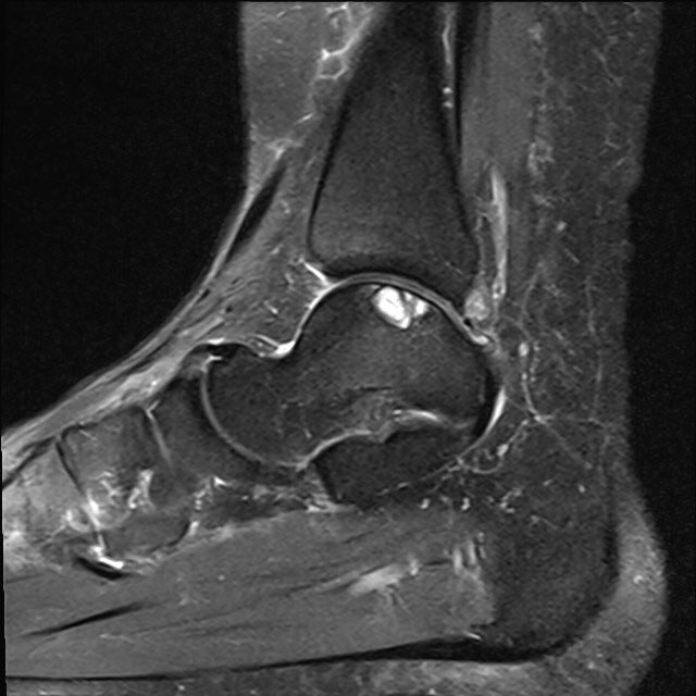 yorfac's tweet photo. @YorkshireRad @JO_SaveTheJoint @AvoJim81 @HDFT_Innovation
Cystic medial talar OCD.
Treated with nanofracture, autologous bone graft & ChondroGide patch.
Pre-op MRI.
Repeat MRI 5 months post-op after AMIC treatment. https://t.co/kU1dgGBRa9