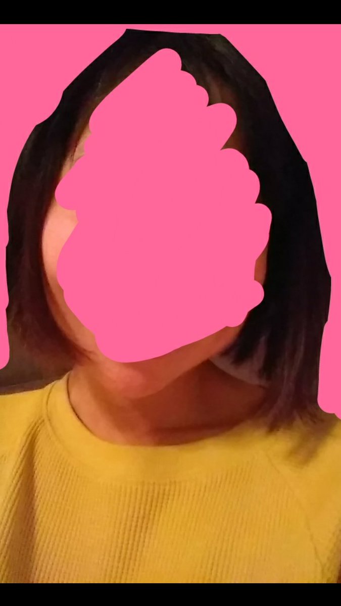 術後半年、腫れはもうほとんどありません。
次は人中レポします。 https://t.co/JRVtX15NCP