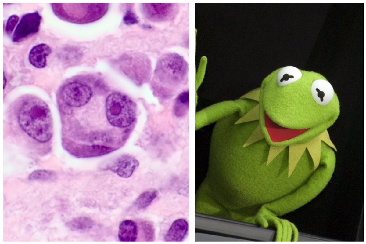 Among Reed-Sternberg variants, "Muppetoid cells" are surely the rarest. This one - a Kermitocyte - was from a case of Hodgkin Lymphoma involving only a single group of cervical lymph nodes, as confirmed by mupPET-CT. 

#hemepath #pathart #pathology #hematology