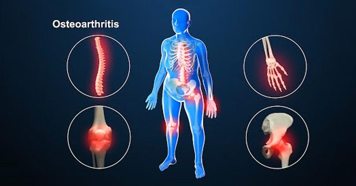 Osteoartritis inflamatoria